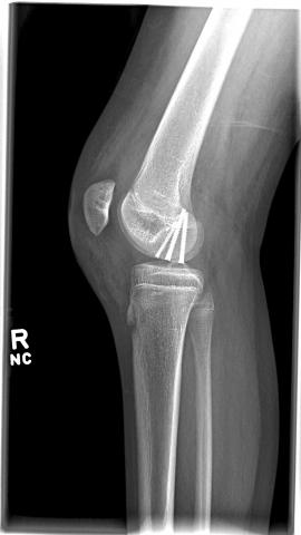Knee X-Ray showing screws going through growth plate in her small bone